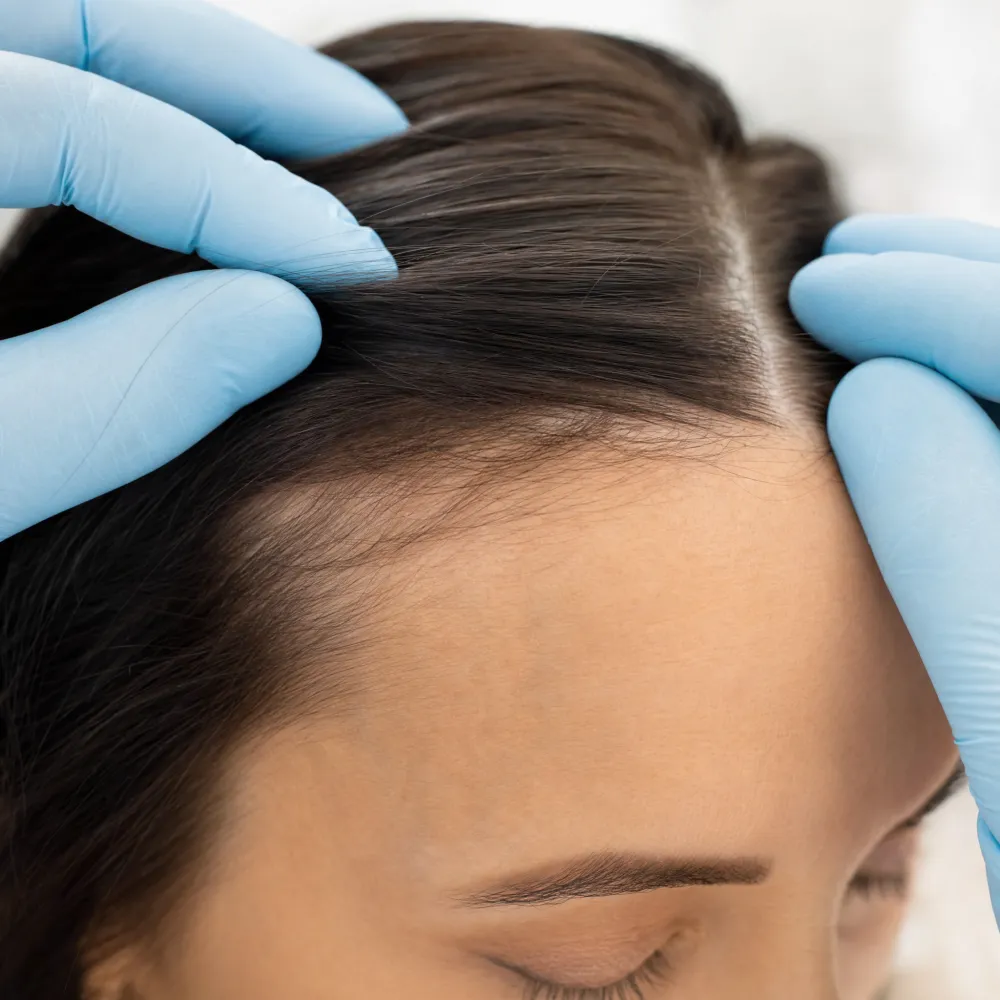 Scalp and hairline detail during a hair restoration treatment at Activate Beauty in Miami.