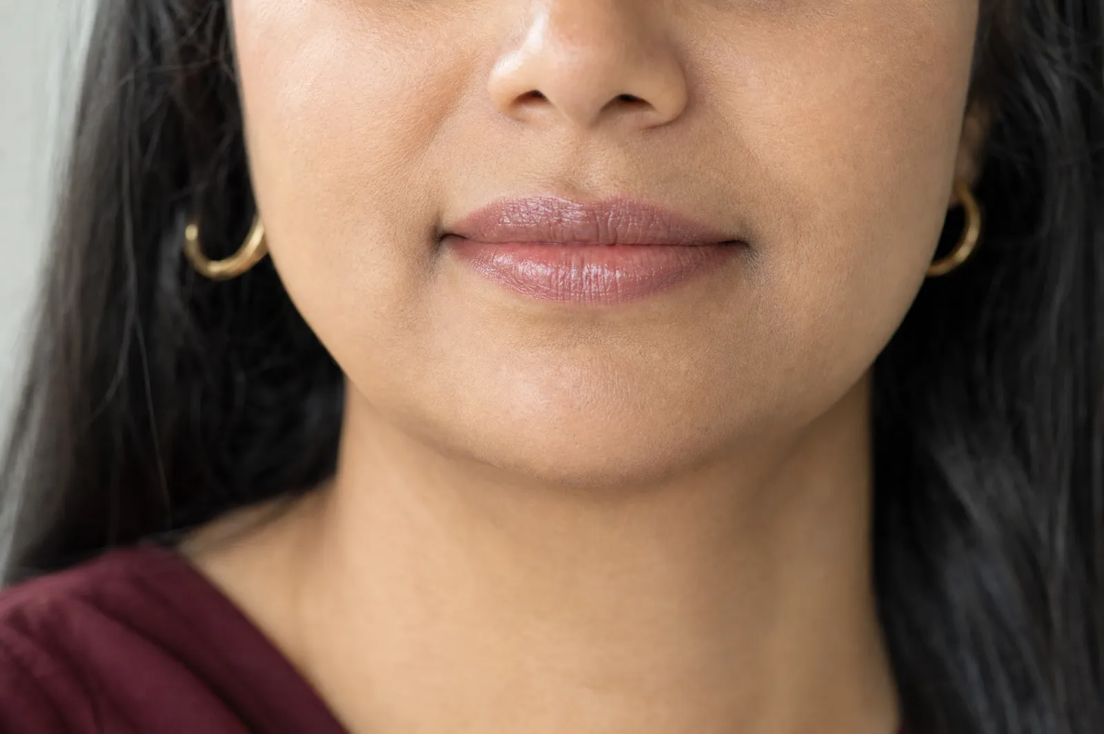 Lip and mid-face dermal filler