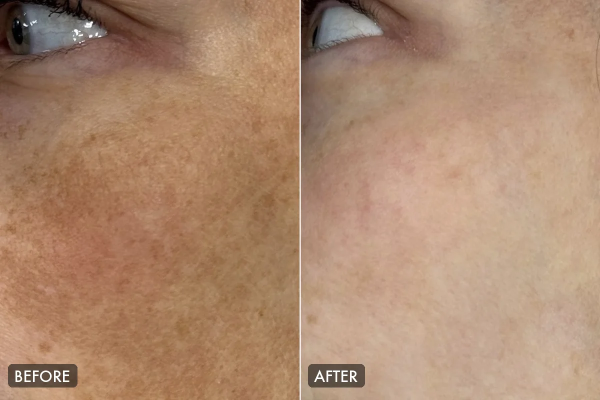 Before and after Dermamelan Plus: melasma on the cheek before treatment and a more even skin tone after. Individual results vary.